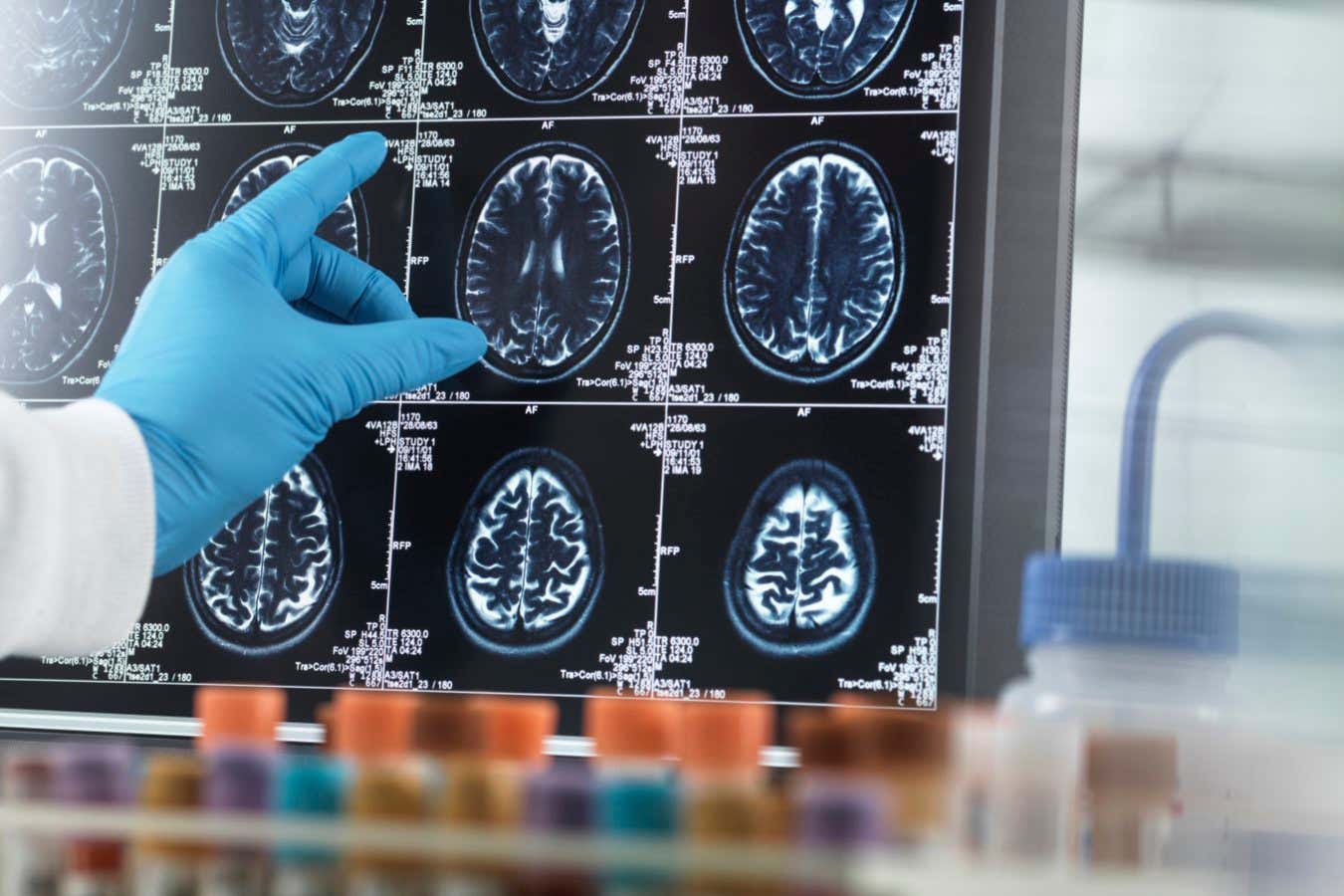 Medicines such as OzemPIC and Wegovy can cut the risk of dementia significantly star-news.press/wp