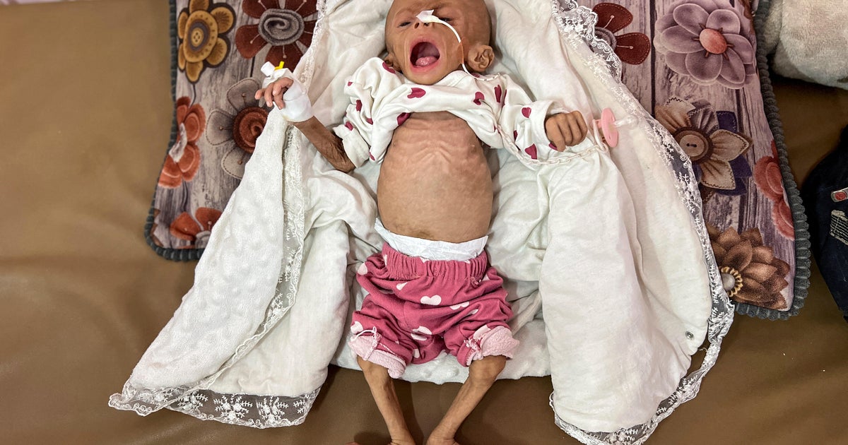 Gaza Hospital coach says that 21 children have died due to malnutrition, and have been injured over the past 3 days star-news.press/wp