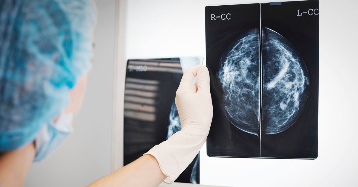 Research reveals how fat cells can have fuels of breast cancer tumors star-news.press/wp