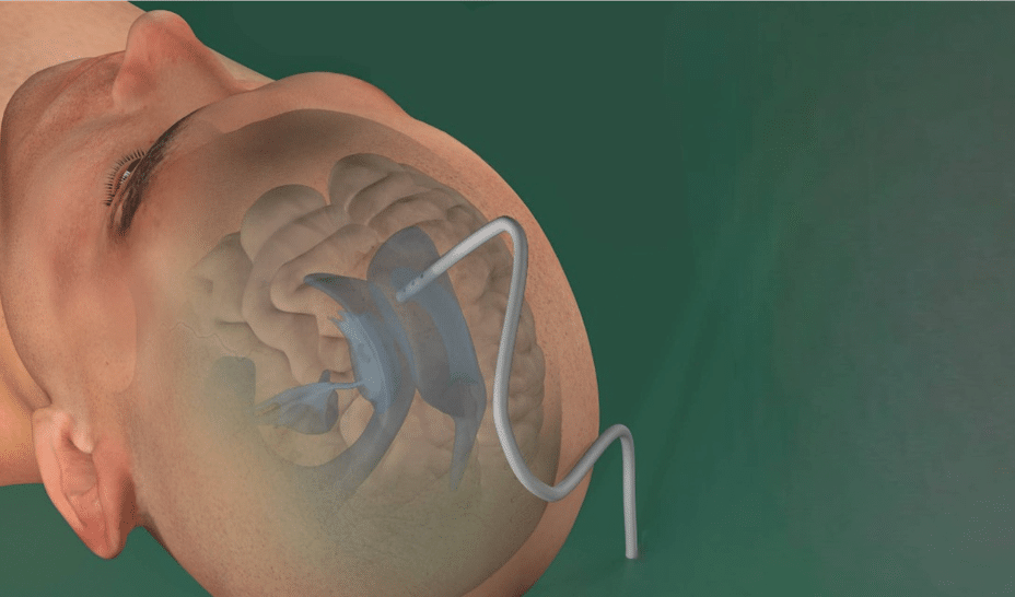 Swiss Medtech Startup Rovica Raises $ 2.5m for emergency neurosurgical devices